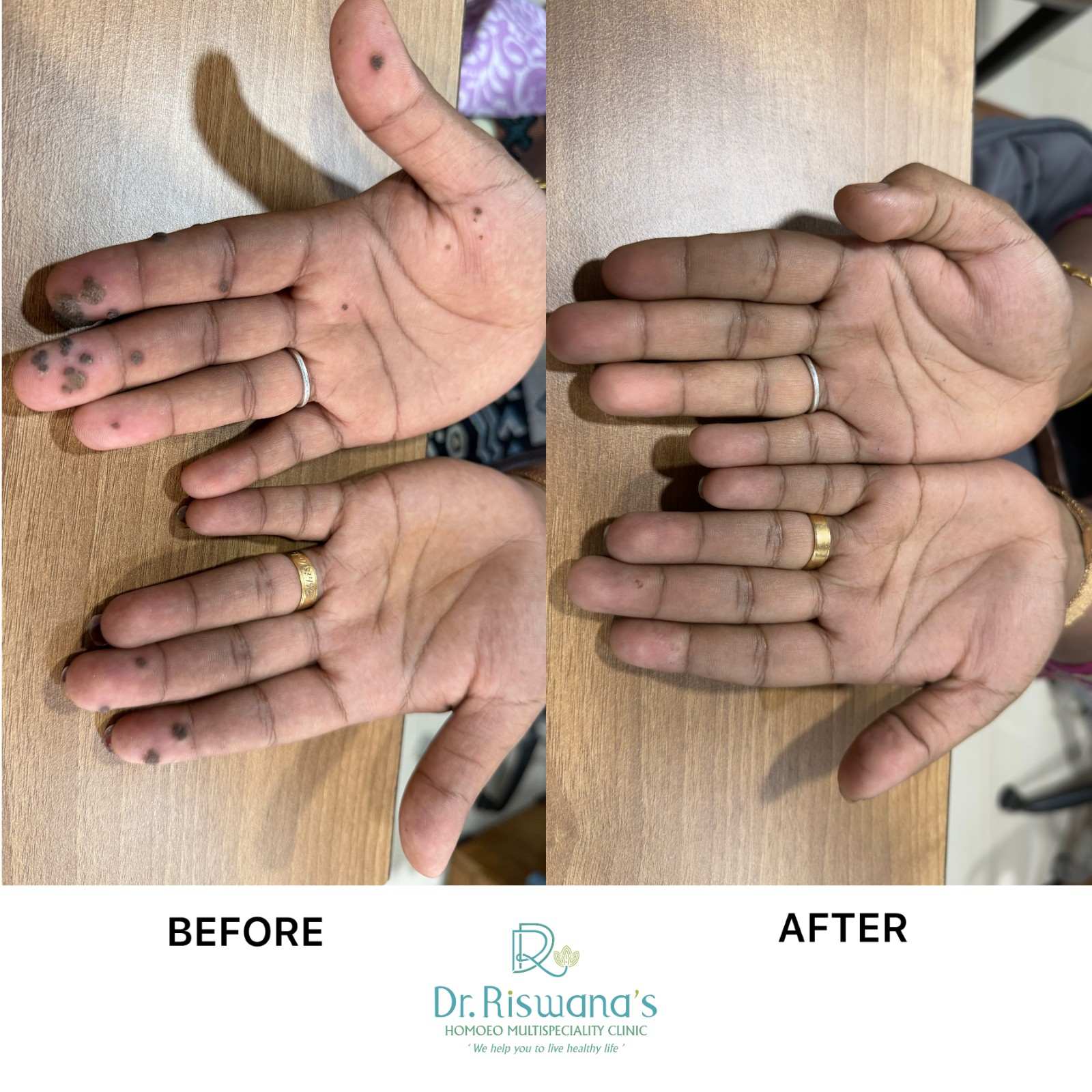 Warts on fingers