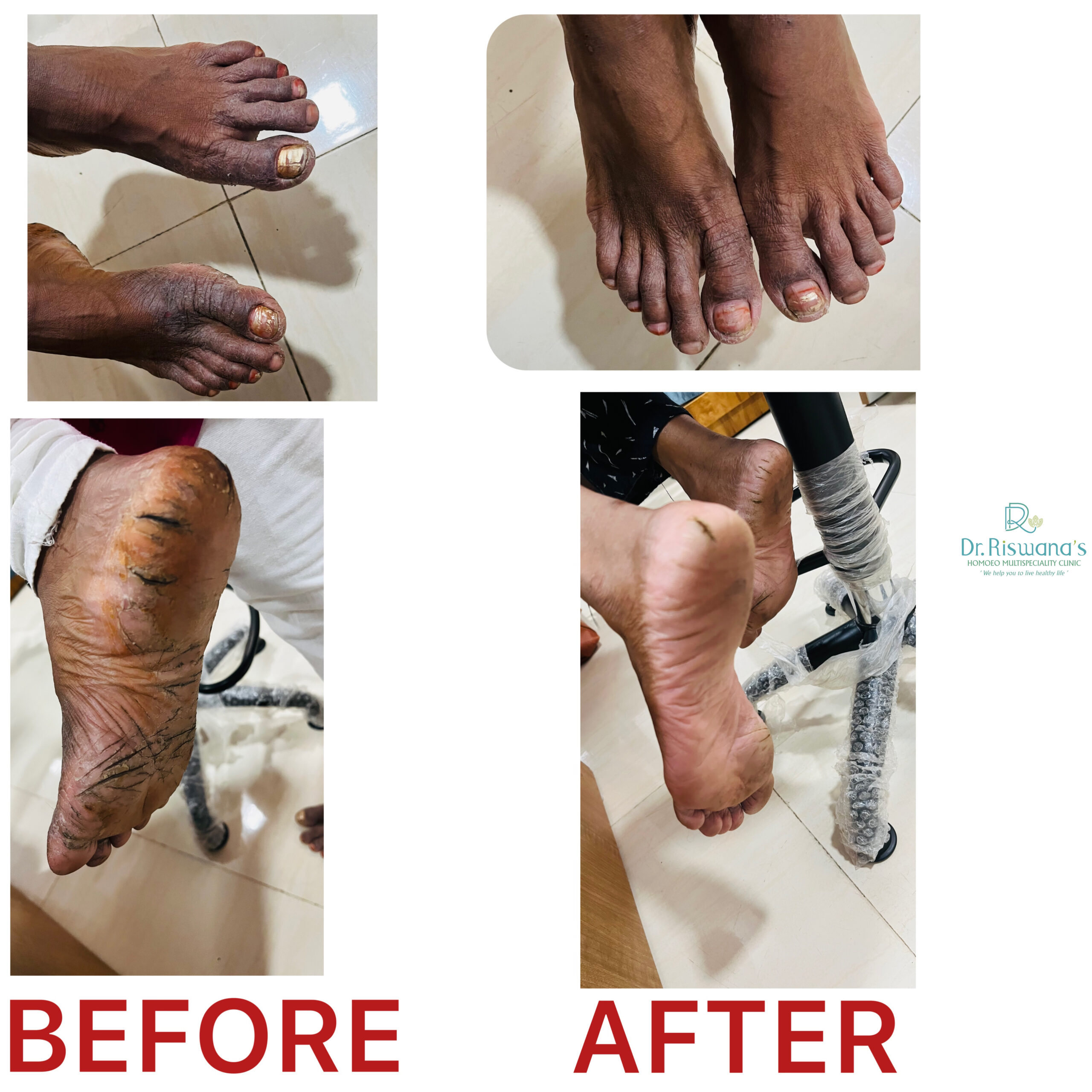 Cracks with eczema