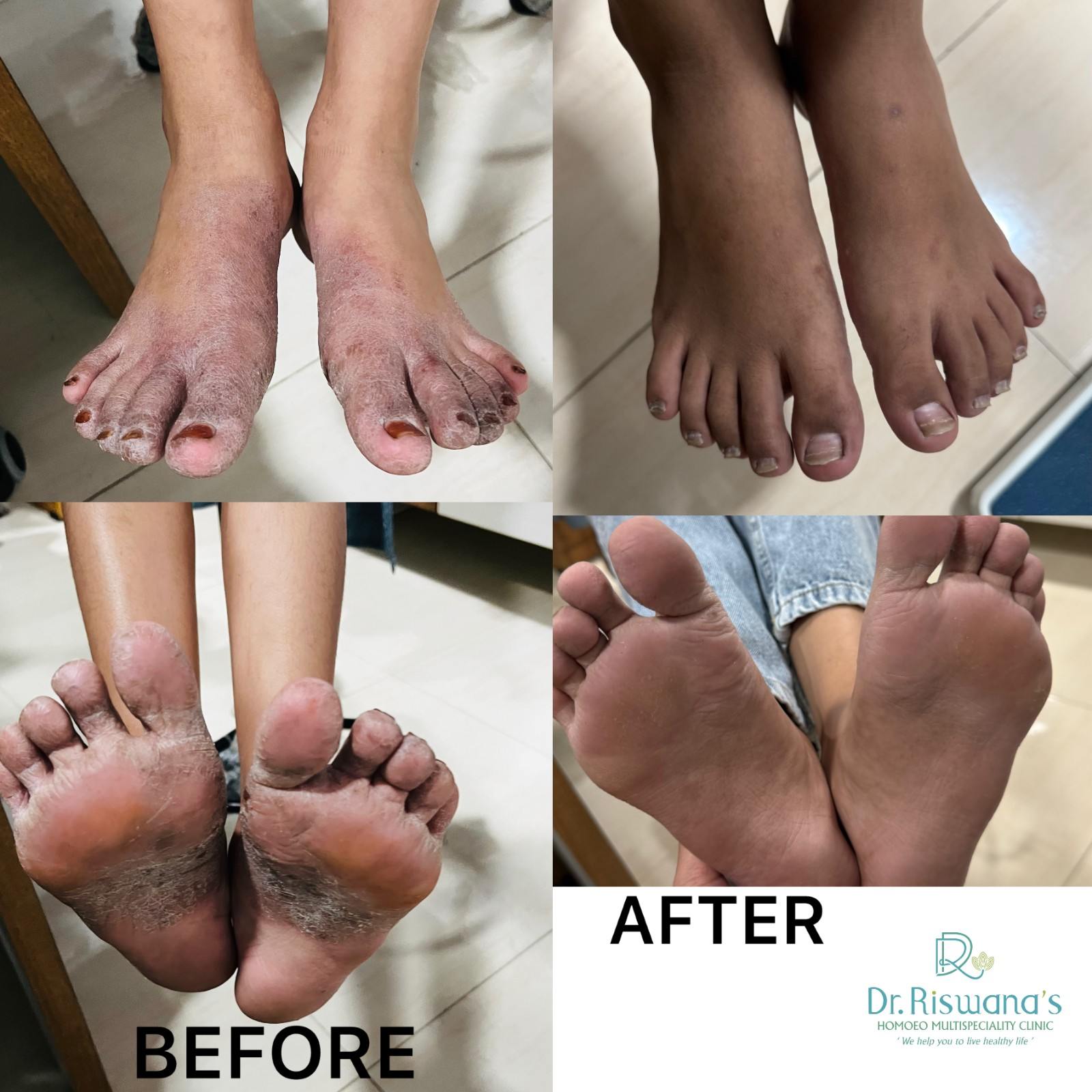 Eczema