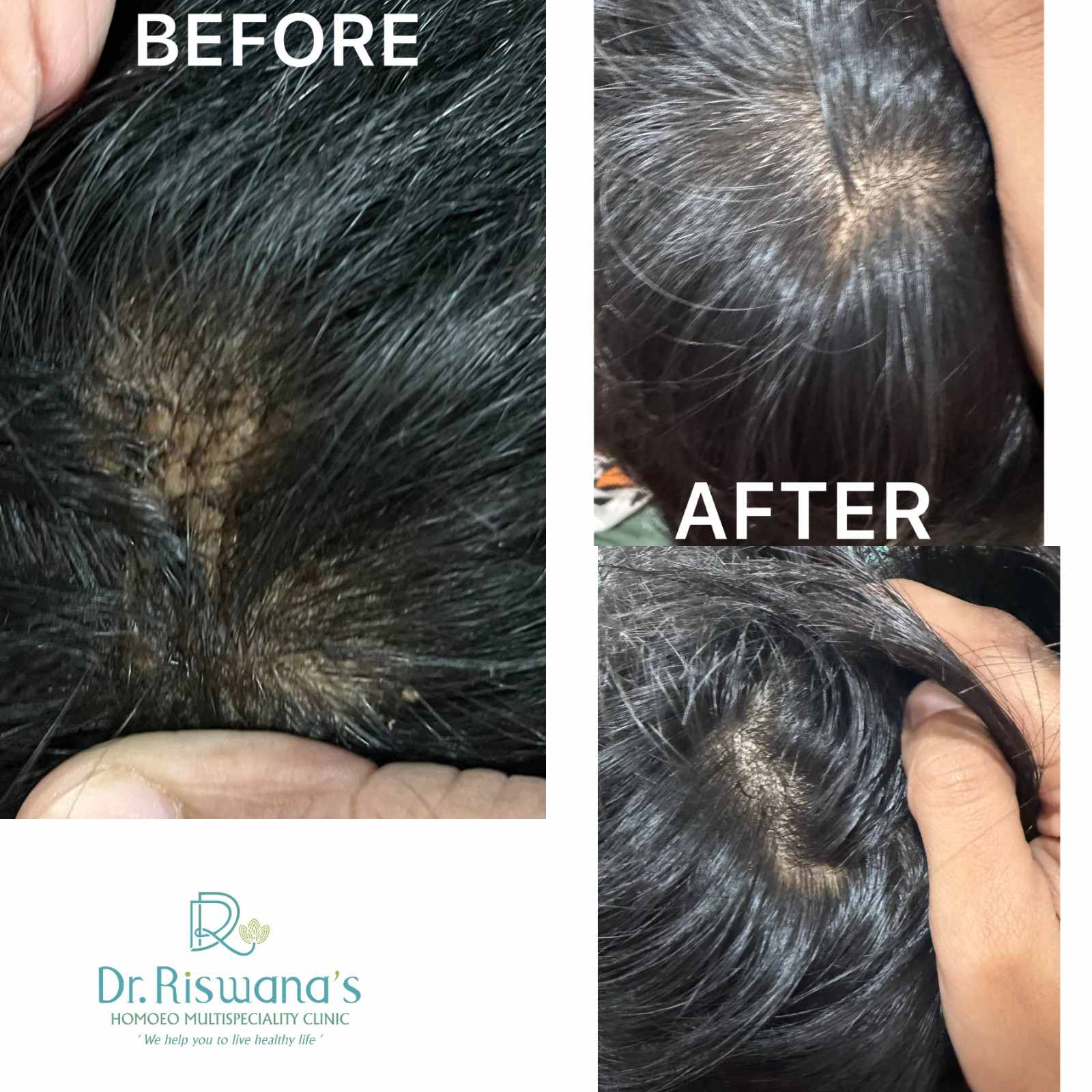 Warts on scalp